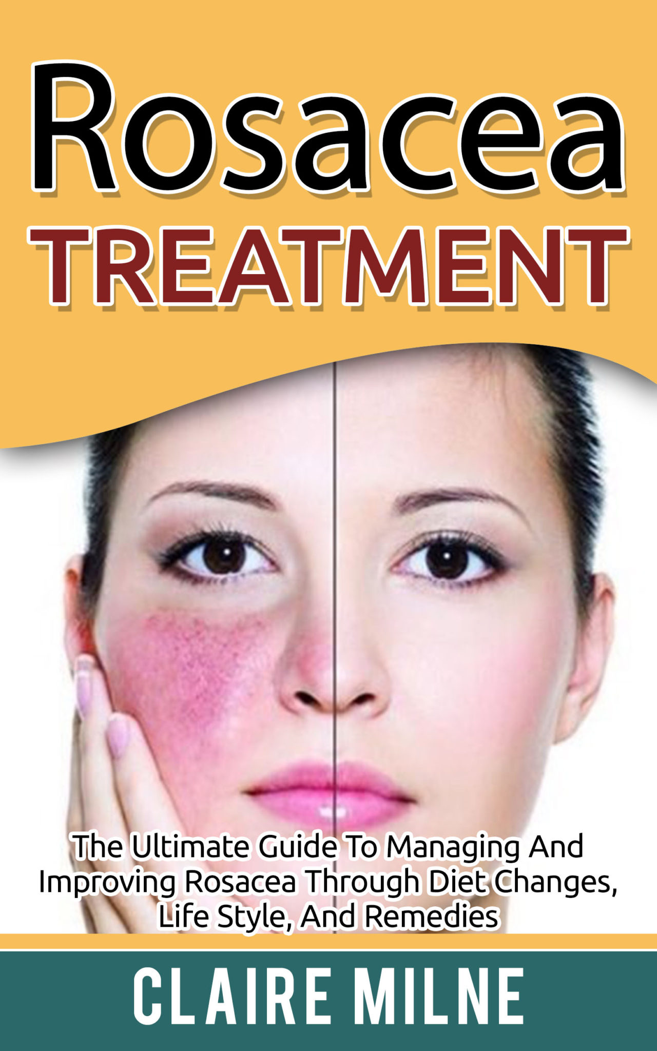 FREE: Rosacea Treatment: The Ultimate Guide To Managing And Improving Rosacea Through Diet Changes, Lifestyle, And Remedies by Claire Milne